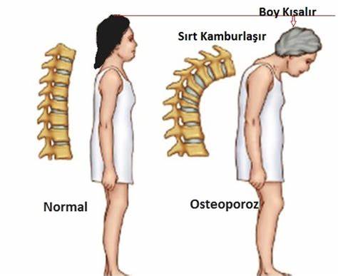 Kadınlarda kemik erimesi-Osteoporoz